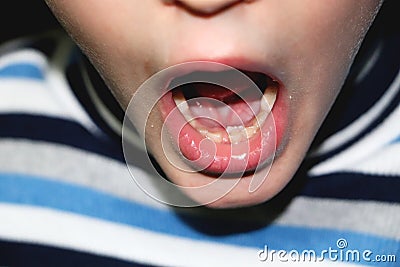 Changing milk teeth. An over-set of teeth, the boyâ€™s milk teeth have not yet fallen out, but indigenous Stock Photo